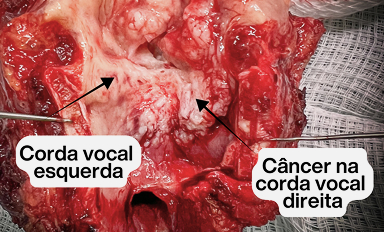 Cordas vocais (tumor na na corda vocal direita)