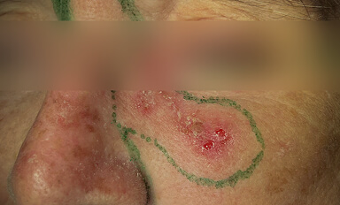 Carcinoma Basocelular