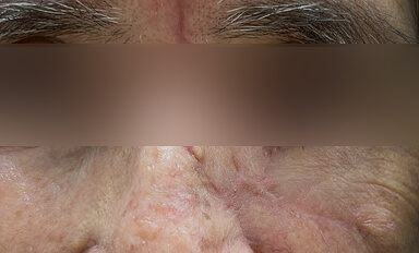Carcinoma Basocelular pós-cirúrgico